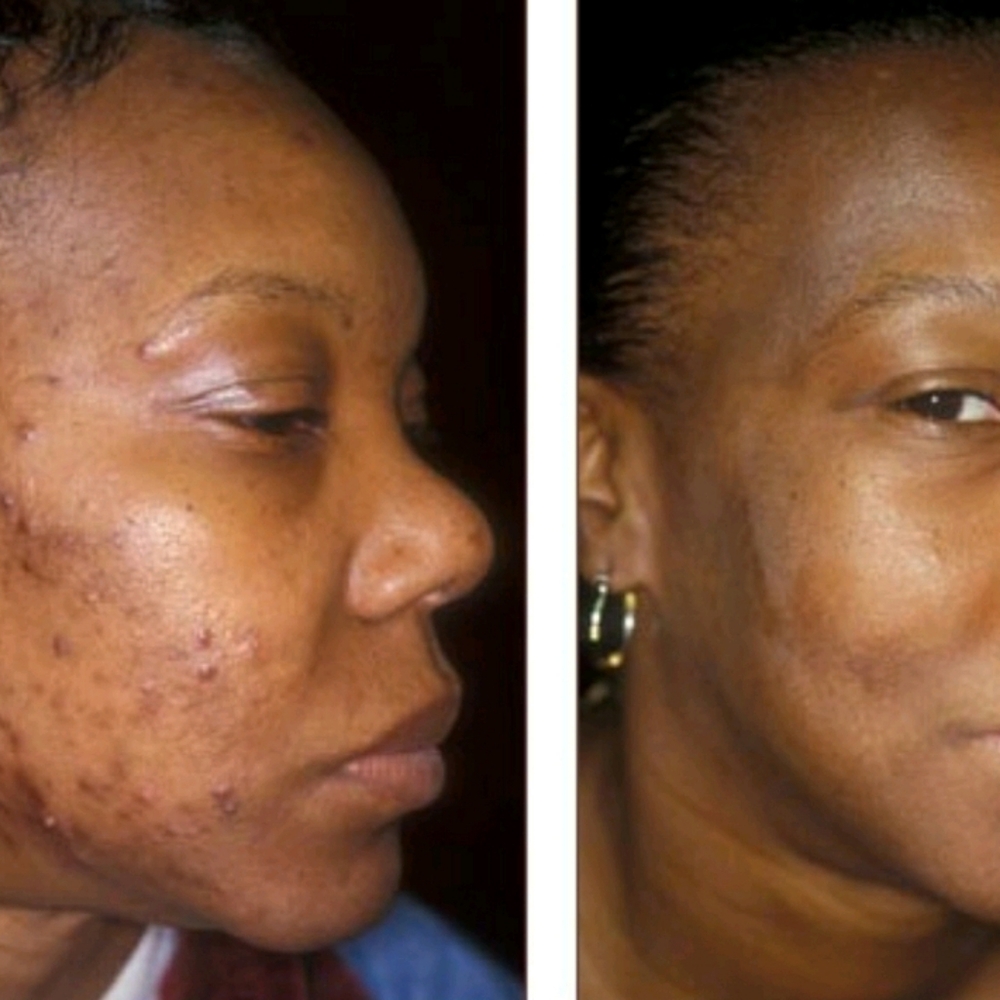 Acne Remover